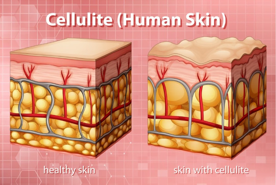 Say Goodbye to Cellulite: Causes, Treatment, and Prevention Tips